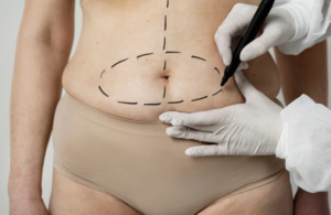 liposuction
