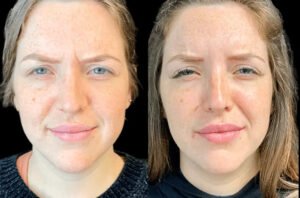 Botox in dubai