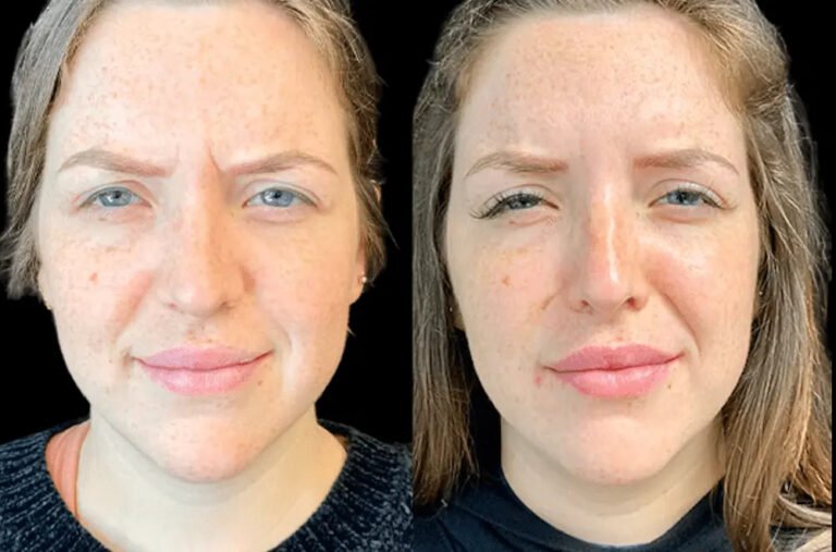 Botox in dubai