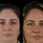 cheek fillers in dubai