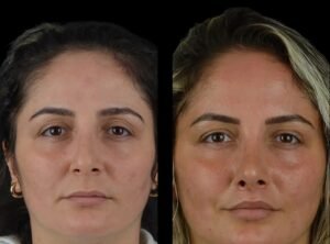 cheek fillers in dubai