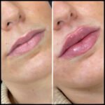 fillers in dubai