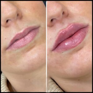 fillers in dubai